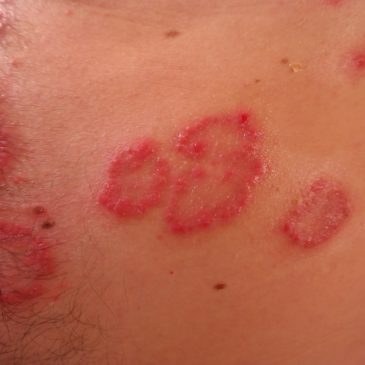 Psoriasis – dermatose – irritation cutanée maladies de peau