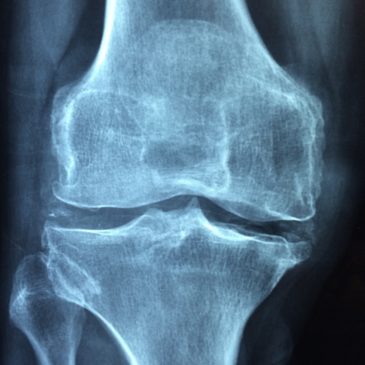 Arthrose arthrite douleurs osseuses